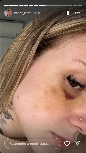 Clara, ex de Caio Paulista, coma marcas de agress&otilde;es que ela alega terem sido dele 