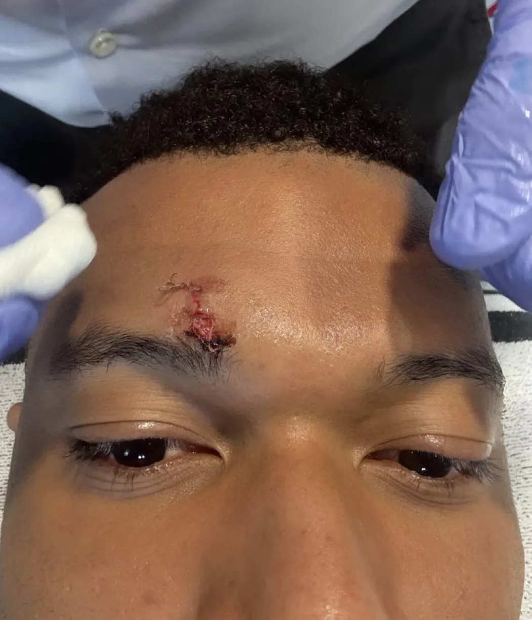 Mbapp&eacute; postou foto lesionado